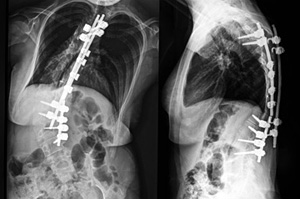 Scoliosis xrays - Copyright – Stock Photo / Register Mark