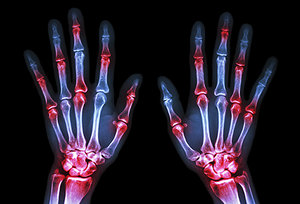 arthritis - Copyright – Stock Photo / Register Mark